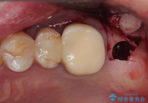 欠損した奥歯 インプラントによる補綴治療