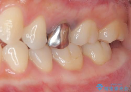笑った時に目立つ銀歯を治したい オールセラミッククラウンの治療前