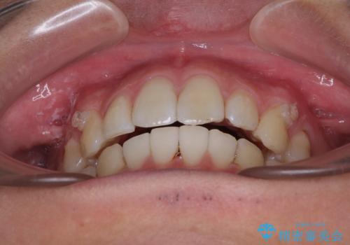 前歯のデコボコをインビザラインで綺麗に改善の治療中