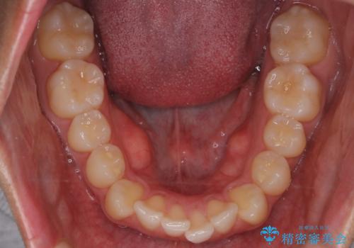 【インビザラインモニター】前歯が出ているのが気になるの治療前