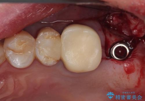 欠損した奥歯 インプラントによる補綴治療の治療前