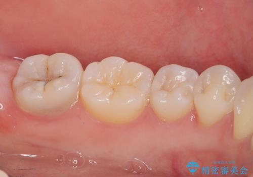 左下に虫歯が見つかった セラミックインレー修復の治療前