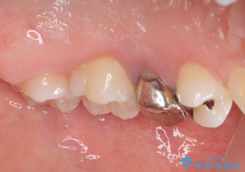 笑った時に目立つ銀歯を治したい オールセラミッククラウンの治療前