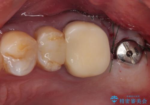 欠損した奥歯 インプラントによる補綴治療の治療中