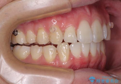 前歯のデコボコをインビザラインで綺麗に改善の治療中