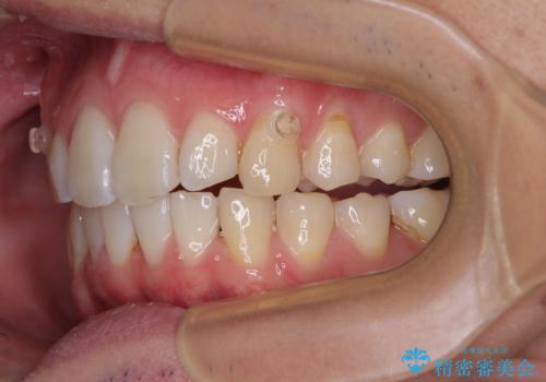 前歯のデコボコをインビザラインで綺麗に改善の治療中