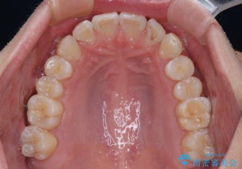 前歯のデコボコをインビザラインで綺麗に改善の治療中