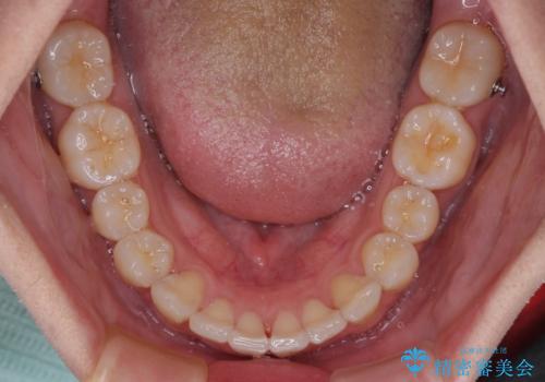 前歯のデコボコをインビザラインで綺麗に改善の治療中