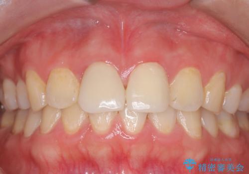 白い被せ物の前に!ホワイトニングで自然な仕上がりに!の治療前