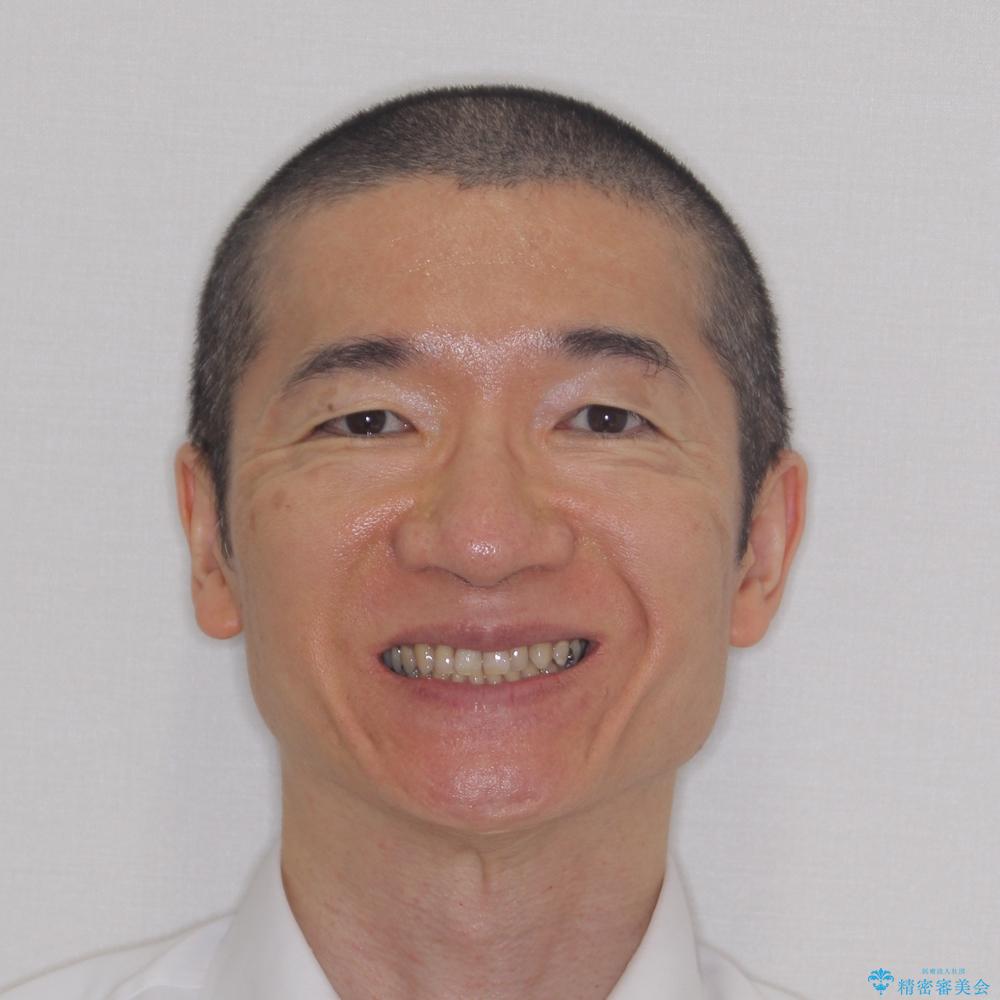 【モニター】ディープバイトで隙間の空いた歯列 ワイヤー装置での非抜歯矯正の治療前(顔貌)