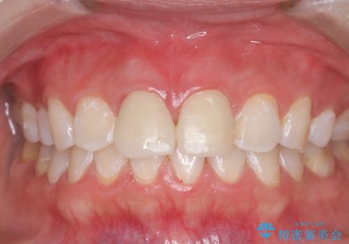 白い被せ物の前に!ホワイトニングで自然な仕上がりに!の治療後