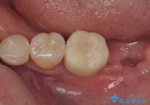 ブリッジから膿が出る 奥歯のインプラント治療の症例 治療後