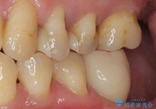 ブリッジから膿が出る 奥歯のインプラント治療の治療後
