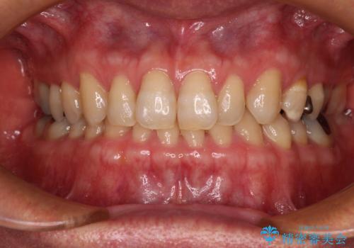 【モニター】ディープバイトで隙間の空いた歯列 ワイヤー装置での非抜歯矯正の症例 治療前
