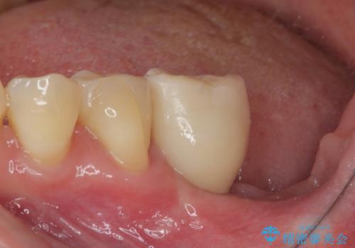 ブリッジから膿が出る 奥歯のインプラント治療の治療後