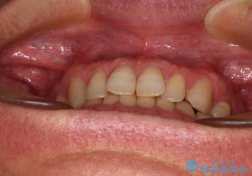 【モニター】ディープバイトで隙間の空いた歯列 ワイヤー装置での非抜歯矯正の治療前