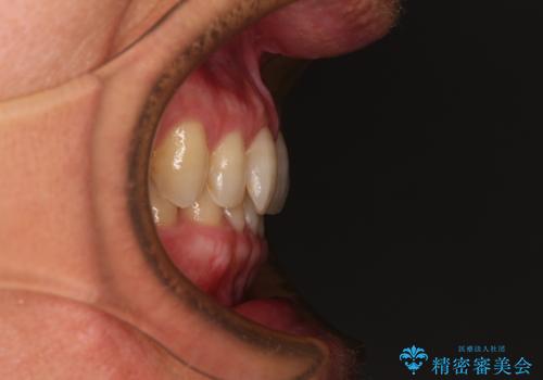 【モニター】ディープバイトで隙間の空いた歯列 ワイヤー装置での非抜歯矯正の治療前