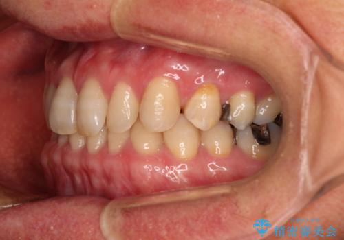 【モニター】ディープバイトで隙間の空いた歯列 ワイヤー装置での非抜歯矯正の治療前