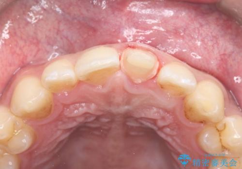 サーフィンで前歯をぶつけて歯が欠けた|かかりつけ医で治療困難と言われ当院へ来院|VPT(生活歯髄療法)で神経を保存|前歯の見た目も改善の治療中