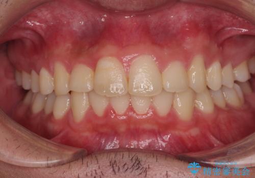 デコボコをインビザライン矯正で改善 奥歯は補助装置で確実に移動をの症例 治療後