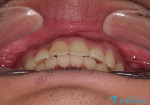 デコボコをインビザライン矯正で改善 奥歯は補助装置で確実に移動をの治療後