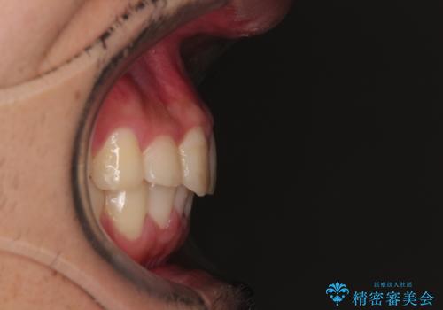 デコボコをインビザライン矯正で改善 奥歯は補助装置で確実に移動をの治療後