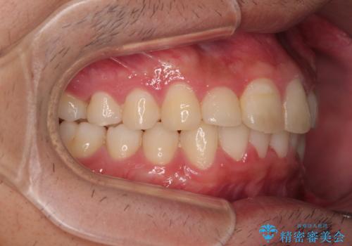デコボコをインビザライン矯正で改善 奥歯は補助装置で確実に移動をの治療後
