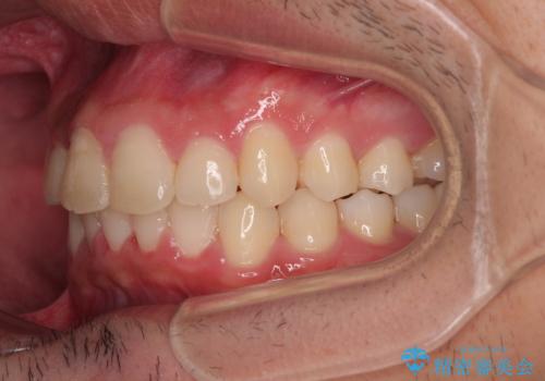 デコボコをインビザライン矯正で改善 奥歯は補助装置で確実に移動をの治療後