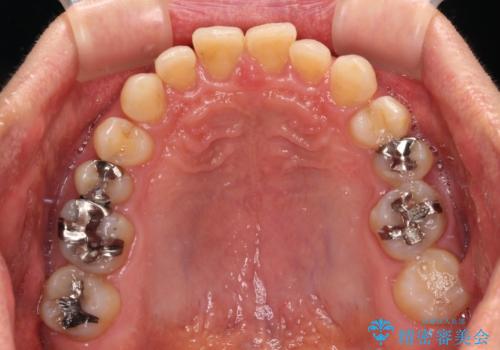 【モニター】ディープバイトで隙間の空いた歯列 ワイヤー装置での非抜歯矯正の治療前