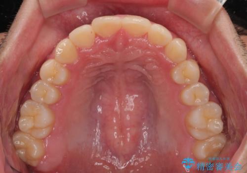 デコボコをインビザライン矯正で改善 奥歯は補助装置で確実に移動をの治療後