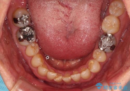 【モニター】ディープバイトで隙間の空いた歯列 ワイヤー装置での非抜歯矯正の治療前