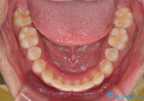 デコボコをインビザライン矯正で改善 奥歯は補助装置で確実に移動をの治療後