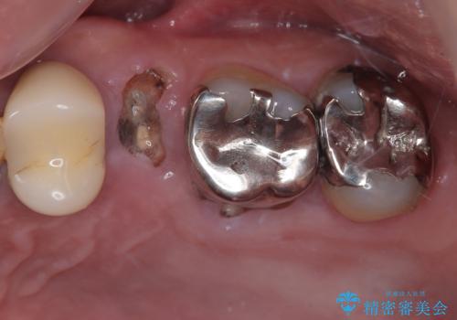 外科処置は一度だけ|抜歯即時インプラントで短期間で自然な見た目へ