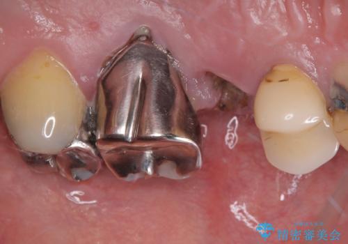 外科処置は一度だけ|抜歯即時インプラントで短期間で自然な見た目への治療前