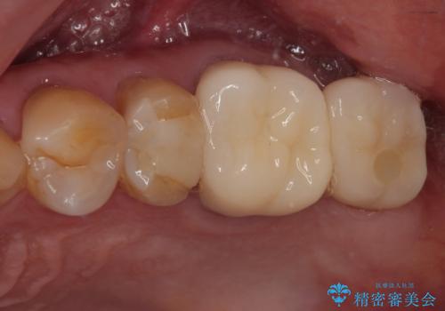 欠損した奥歯 インプラントによる補綴治療の症例 治療後