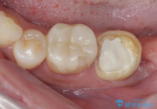 抜歯即時インプラントで治療期間を大幅短縮!抜歯からセラミックまでを3か月で完了の症例 治療前