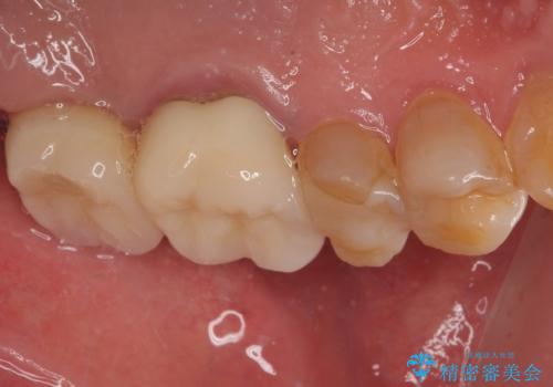欠損した奥歯 インプラントによる補綴治療の治療後