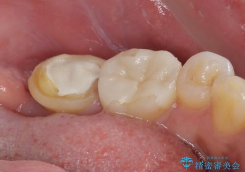 抜歯即時インプラントで治療期間を大幅短縮!抜歯からセラミックまでを3か月で完了の治療前