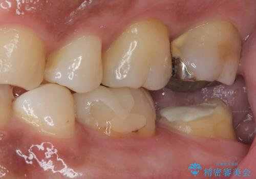抜歯即時インプラントで治療期間を大幅短縮!抜歯からセラミックまでを3か月で完了の治療前