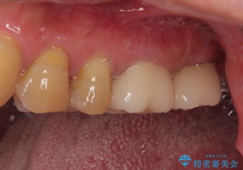 欠損した奥歯 インプラントによる補綴治療の治療後
