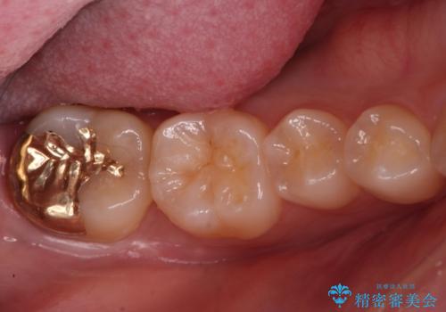 虫歯治療後、精度の良いゴールドアンレーへの症例 治療後
