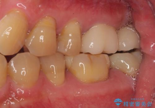 欠損した奥歯 インプラントによる補綴治療の治療後