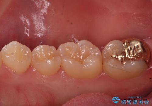 虫歯治療後、精度の良いゴールドアンレーへの治療後