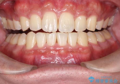 矯正後の初めてのホワイトニングの治療前