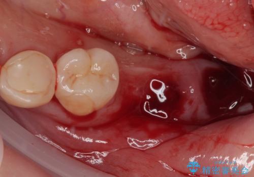 ブリッジから膿が出る 奥歯のインプラント治療の治療前