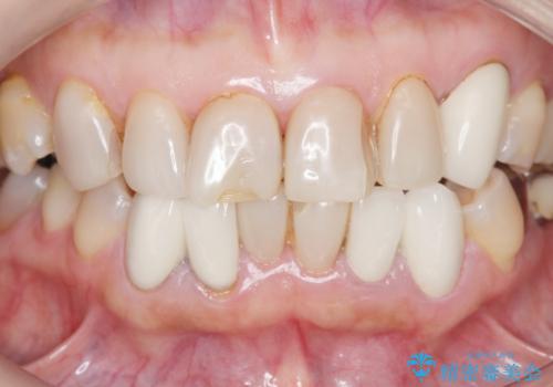 前歯クラウン(オールセラミック)の症例 治療前