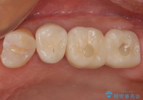 非常に骨が薄い奥歯 最短期間でのインプラント治療の症例 治療後