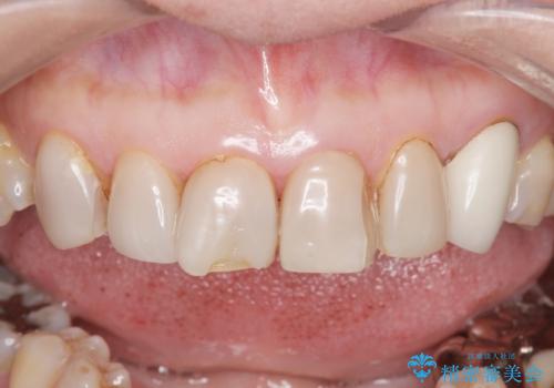 [ セラミック治療 ] 前歯の見た目を改善したいの治療前