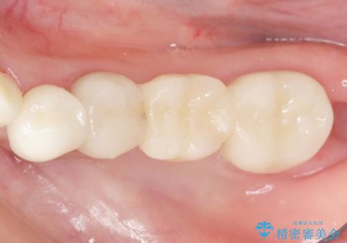 銀歯のブリッジをジルコニアブリッジへの治療後