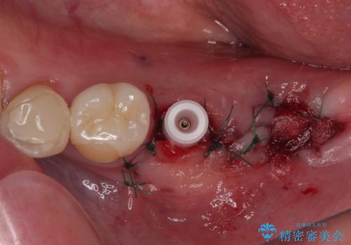 ブリッジから膿が出る 奥歯のインプラント治療の治療中